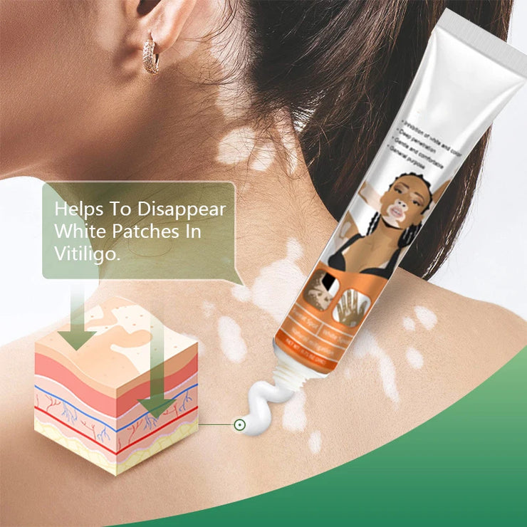 Effectively Remove Vitiligo Ointment Ringworm White Spot Removal Skin Vitiligo Eliminate Vitiligo Skin Care