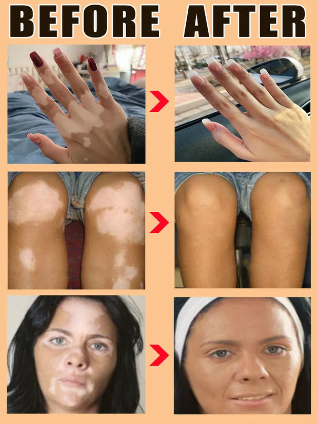 Effectively Remove Vitiligo Ointment Ringworm White Spot Removal Skin Vitiligo Eliminate Vitiligo Skin Care
